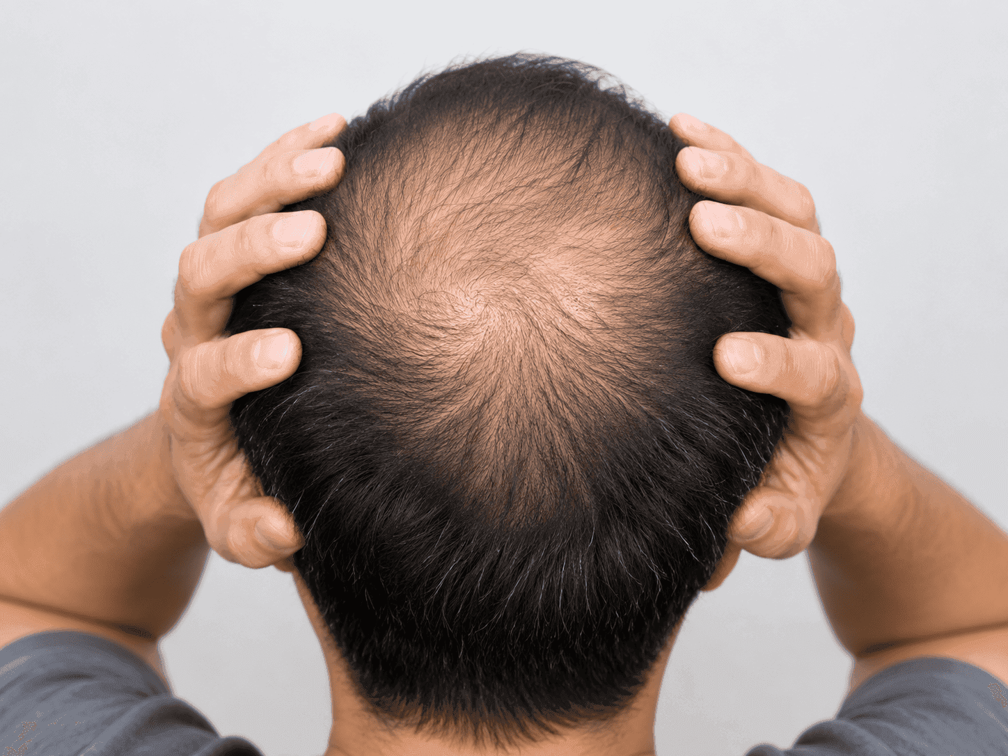 Male pattern hair loss showing crown thinning