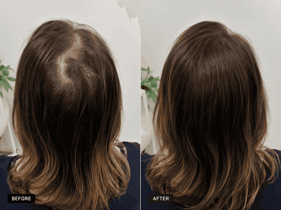 Before and after results for a female HairGain® patient showing improved hair density