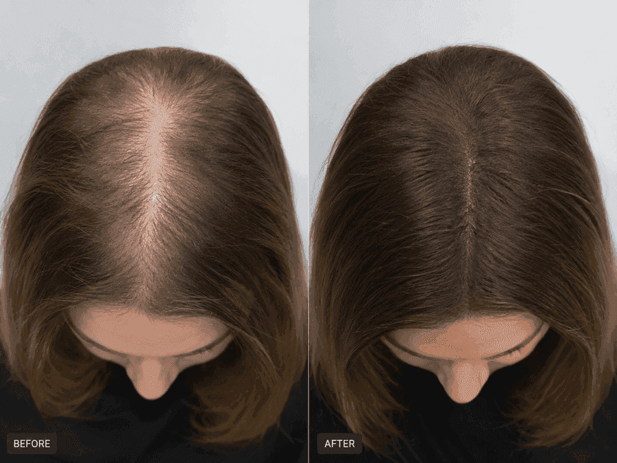 Before and after results for a female HairGain® patient showing thicker hair