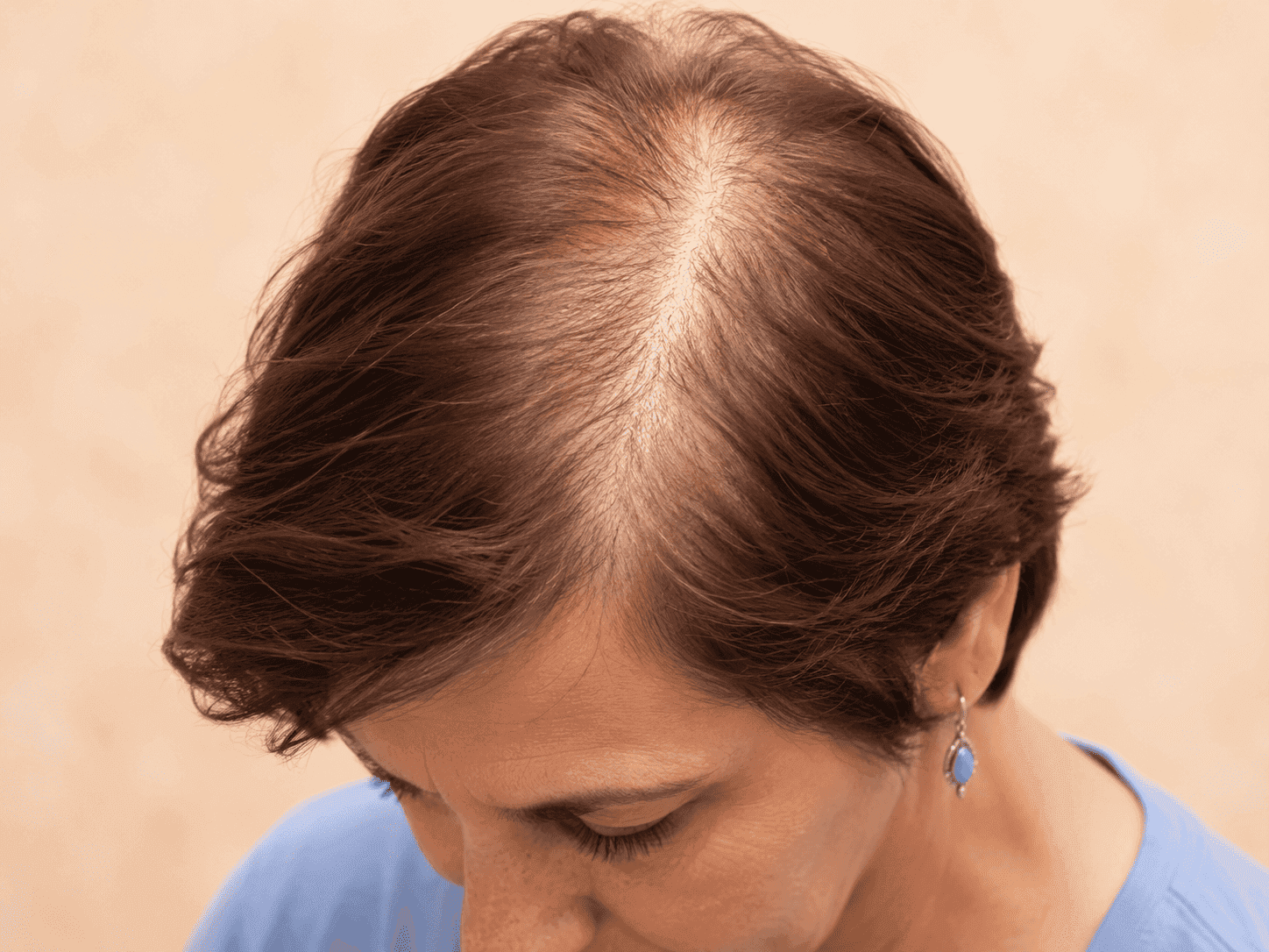 Female hair thinning along the part line